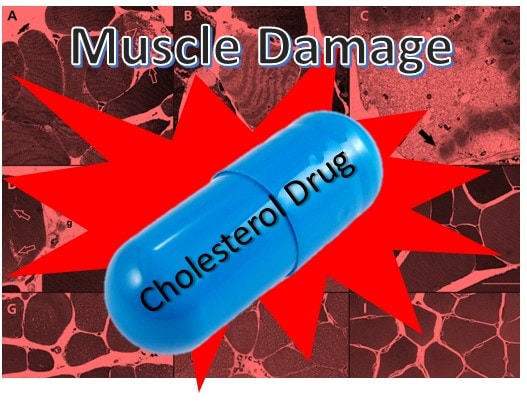 Cholesterol Drugs Harm Muscles