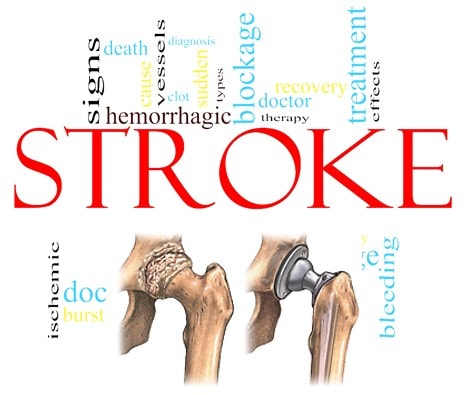 Hip Replacement Surgery Markedly Increases the Risk of Stroke