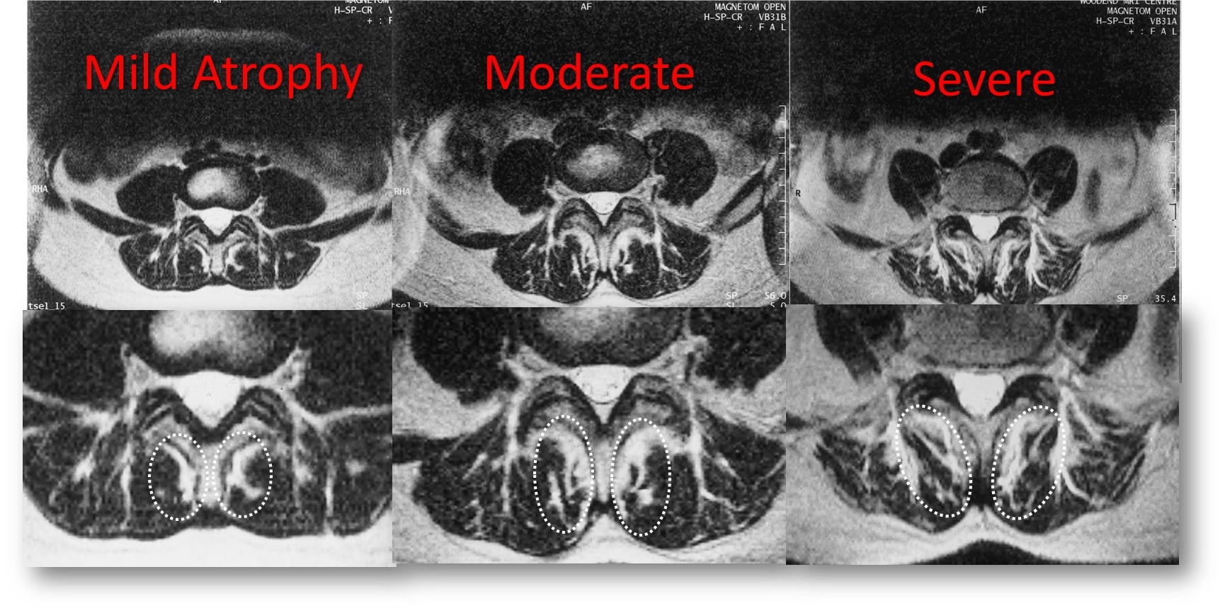 Multifidus Muscle Mri