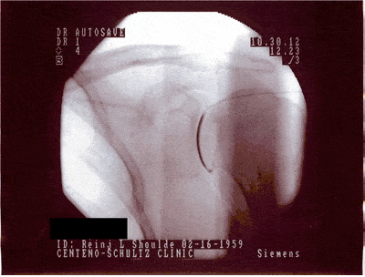 Want to Shorten Shoulder Labrum Surgery Recovery? Ditch the Surgery for an Injection of Your Own Stem Cells