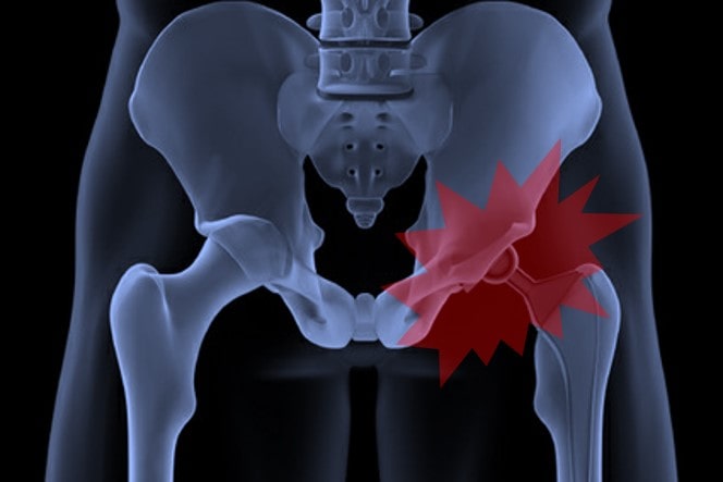 hip replacement side effects
