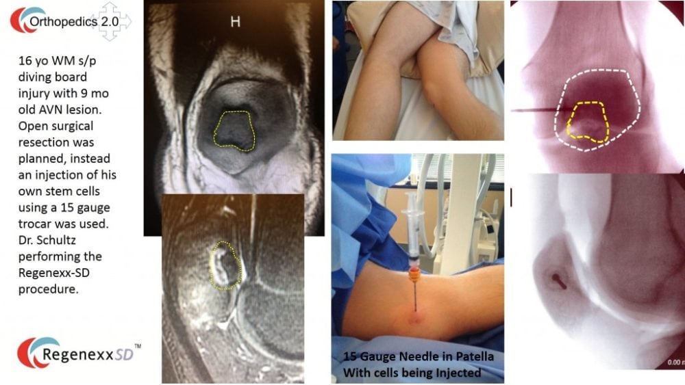Another Intenventional Orthopedics First: Injecting Stem Cells into a Knee Cap with AVN