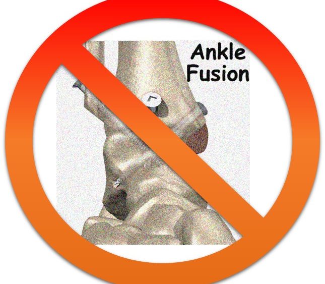 18 Months Out from Seeking an Ankle Fusion Alternative