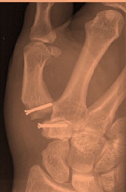 CMC hand joint replacement