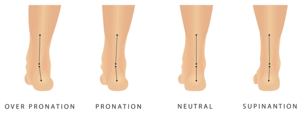 Medical illustration showing neutral human foot, a foot with pronation and a foot with over pronation