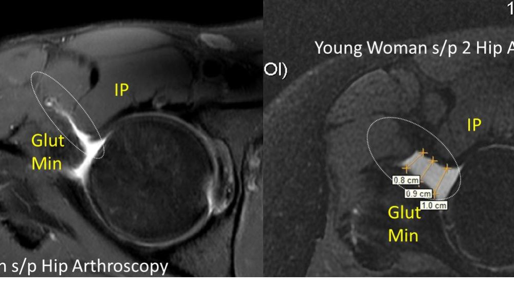 Hip Arthroscopy Side Effects: The Portal Syndrome