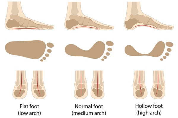 Medical infographic showing the effects of a flat arch, a normal arch and a high arch on bone structure and ankle positioning