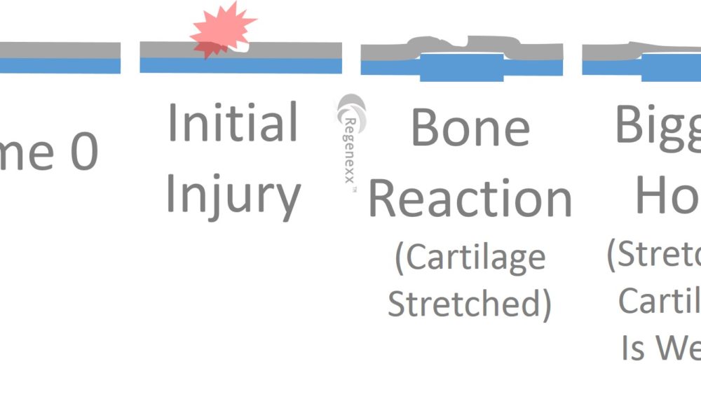 A Hole in Cartilage causes Bone to React and Stretch the Cartilage Resulting in Arthritis