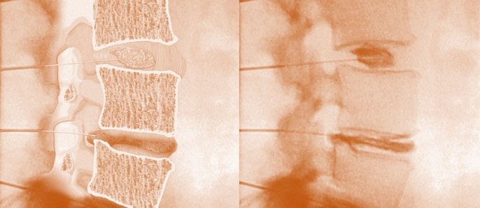 More Discography Side Effects-The Medications Used in Discography May Help Discs Degenerate!