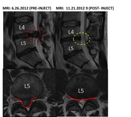 Epidural Steroid Injection Alternative? Resolution of a Large Disc Bulge