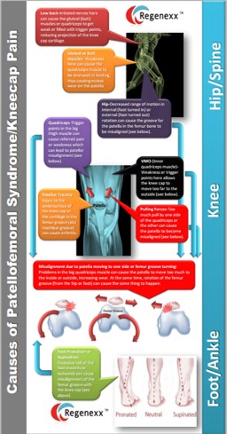 Knee Cap Pain: New MRI Research Shows the Hip Bone is Connected to the Knee Bone…