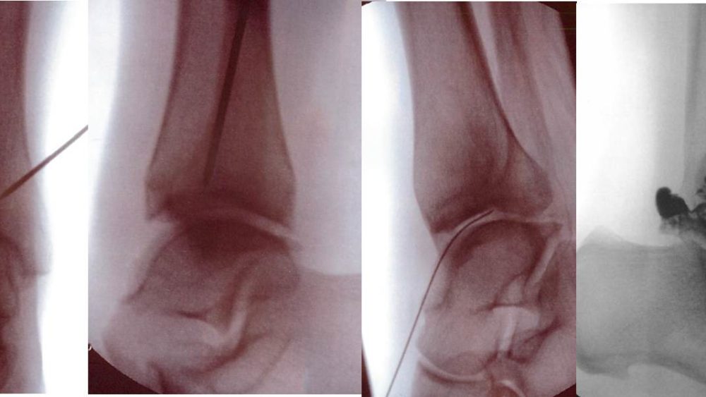 Ankle Surgery Alternative: Using Interventional Orthopedics to Treat Cartilage and Bone Lesions without Surgery