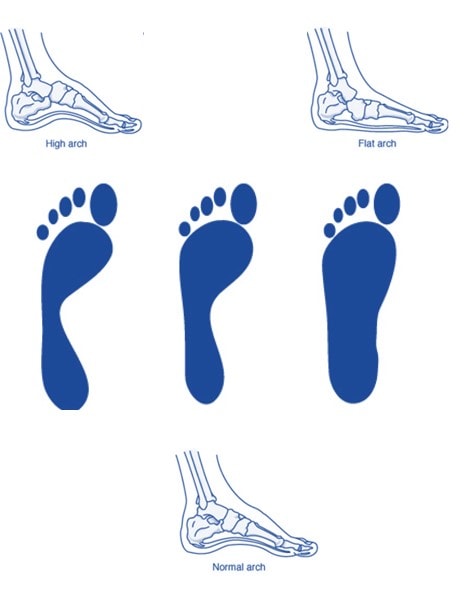 Is There a Flat Feet Knee Pain Relationship? - Regenexx®