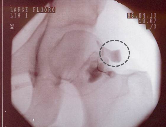 Hip Arthroscopy Complications: More on the Portal Syndrome