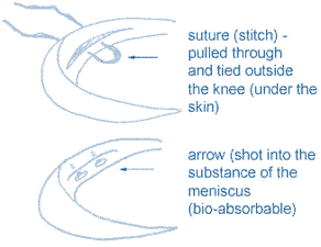 Surgical Meniscus Repair Works…only if You’re Very Young