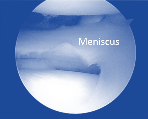 Watch Your Weight if You Have a Meniscus Tear!