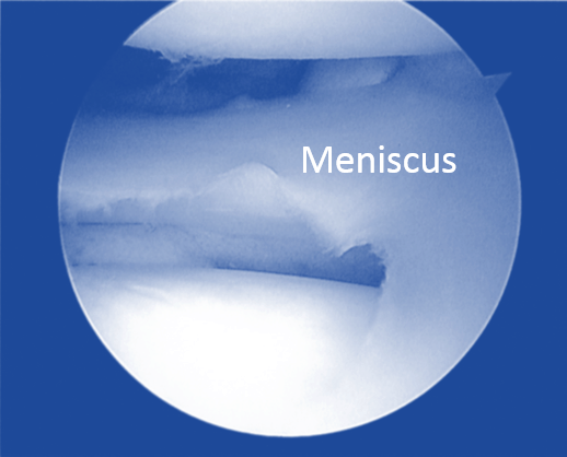 meniscus tear