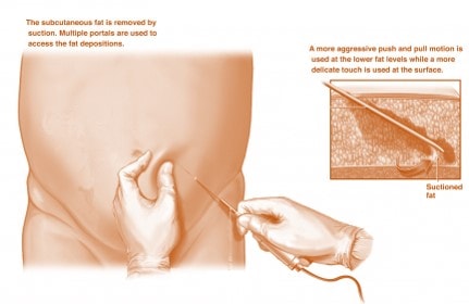 Fat vs. Bone Marrow Stem Cells: A Clinician’s Perspective