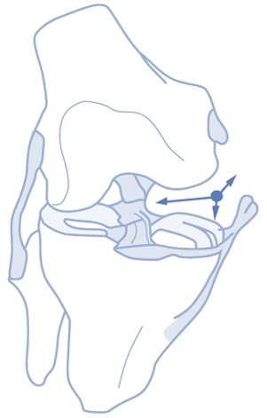 What Terrible Triad? An ACL Injury that’s Really an LCL…