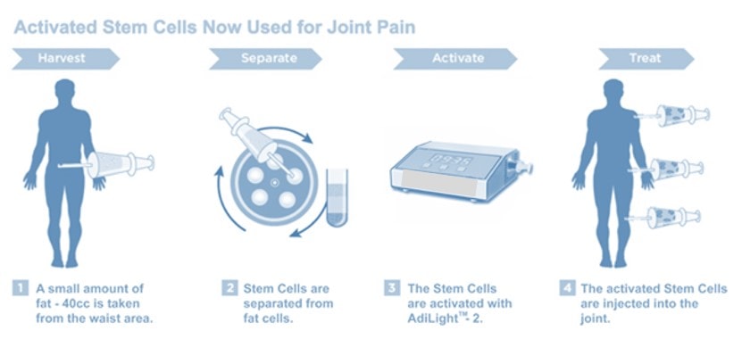 Fat Stem Cell Arthritis Claims? Is Light Activation of Fat Stem Cells Just Another Gimmick or the Real Deal?