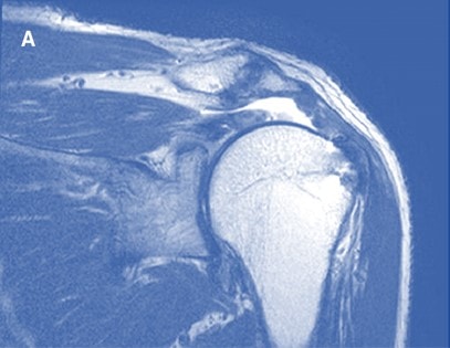 Massive Drop in Rotator Cuff Re-tears when PRP Added during Surgery