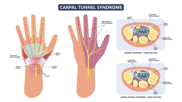 Medical infographic showing the effects of carpal tunnel syndrome incuding an over view of the hand and a cross section of the wrist