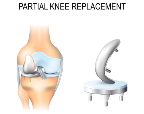 Medical illustration showing a partial knee replacement and the implant