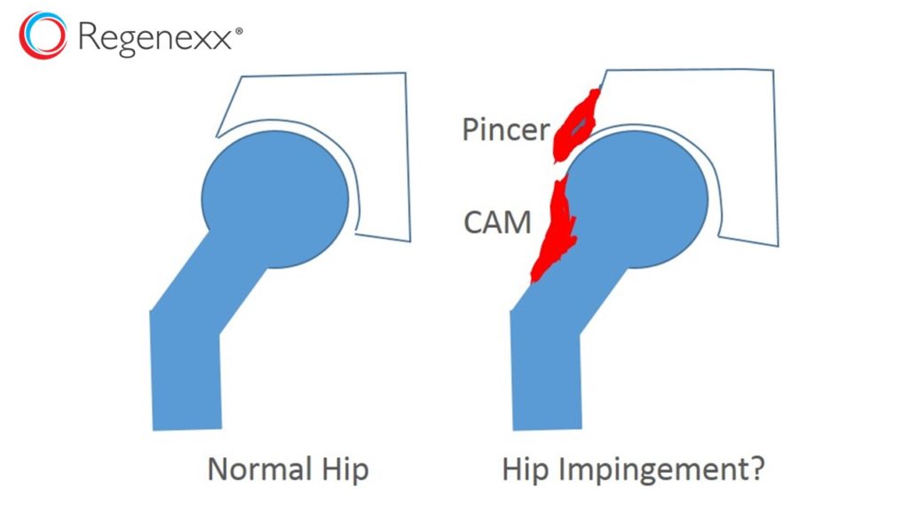 hip impingement surgery