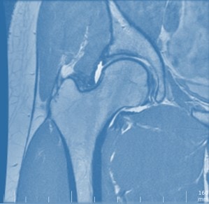 MRI of the hip