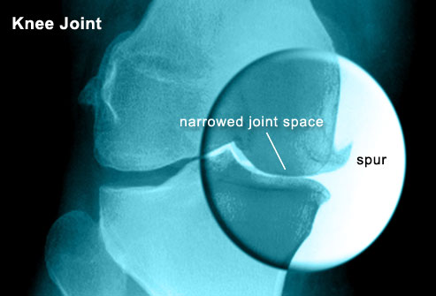 What is a bone spur? Can Bone Spurs be Good? - Regenexx®