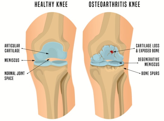 Medical illustration showing a healthy knee and a knee affected by osteoarthritis including bone spurs and a damaged meniscus