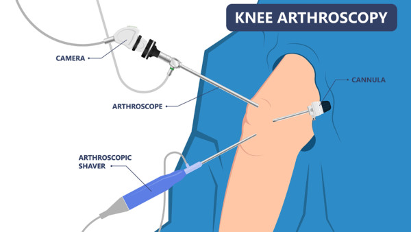 Medical illustration showing an arthroscopic proceedure on the knee