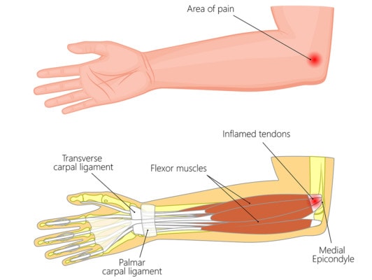 Medical illustration of medial epicondylitis or golfer's elbow