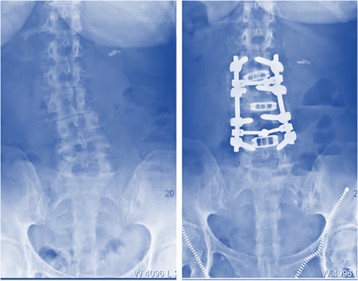 Low Back Fusion Alternatives: Fusion Surgery No Better Than Physical Therapy