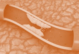 Cholesterol Lowering Drugs Barely Help and Don’t Clear Arteries