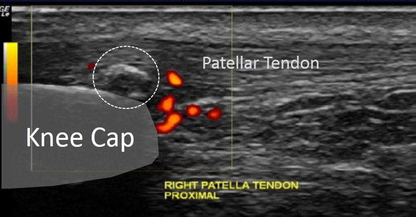 Knee Tendon Surgery Recovery: The Difference Between Regular Bedside PRP and Regenexx SCP