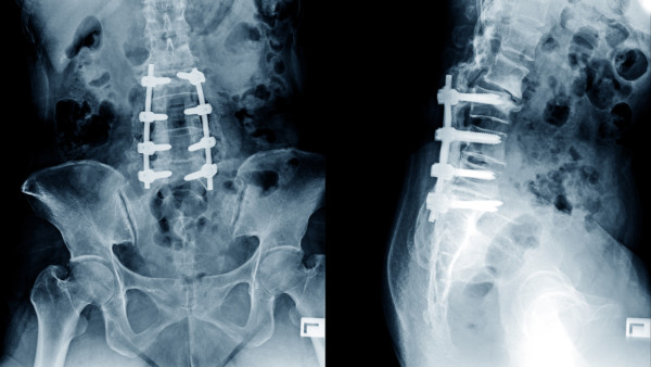 Two X-ray views of low back spinal fusion