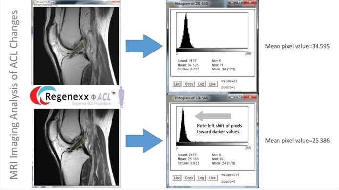ACL Surgery Alternative: Imaging Analysis in our New Stem Cell ACL Tear Studies