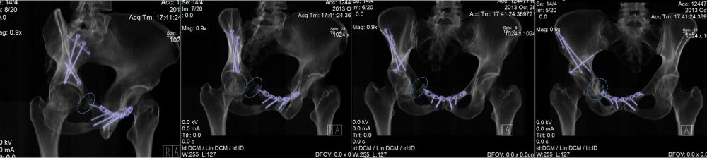 So this is Hip PAO Surgery Recovery? This Patient’s Hip Socket Is Still Disconnected from her Body 9 Months Later