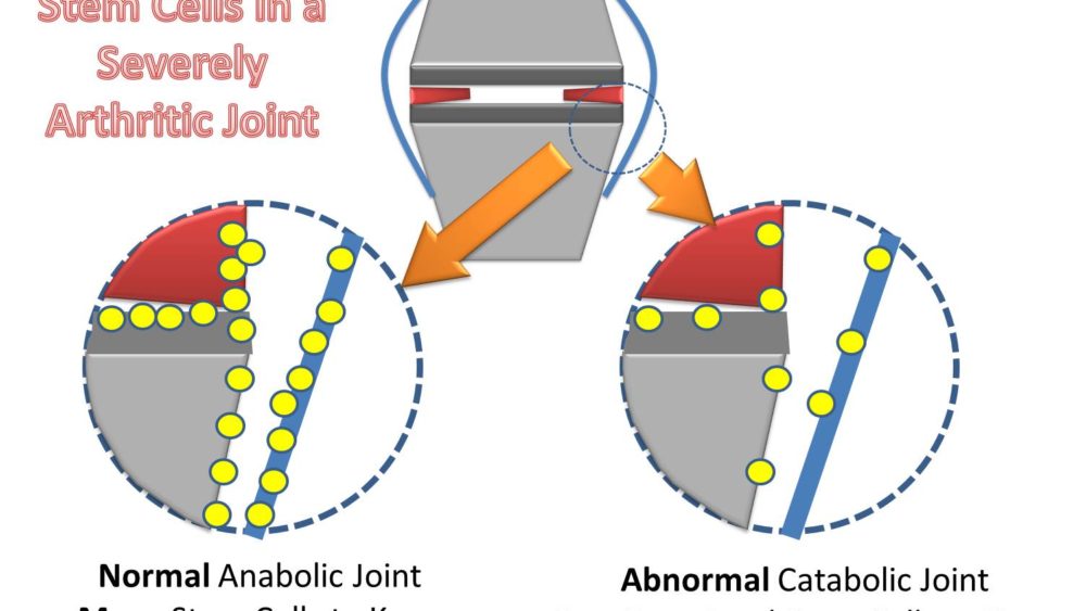 Are there stem cells in my knee? Stem Cell Number in the Synovial Fluid Increases after Knee Meniscus Injury