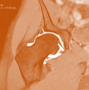 Hip Surgery Labral Tear Recovery