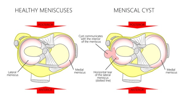 Medical illustration showing a healthy knee and a knee with a meniscal cyst