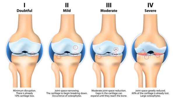 Medical illustration showing the effects of stages of knee osteoarthritis