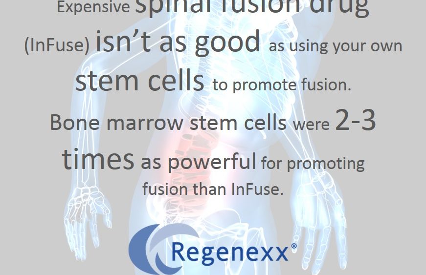 Spinal Fusion Recovery Plan? Use Your Own Bone and Stem Cells Over Expensive Fusion Drugs