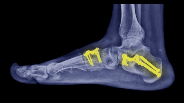 X-ray showing bone fusion in the foot