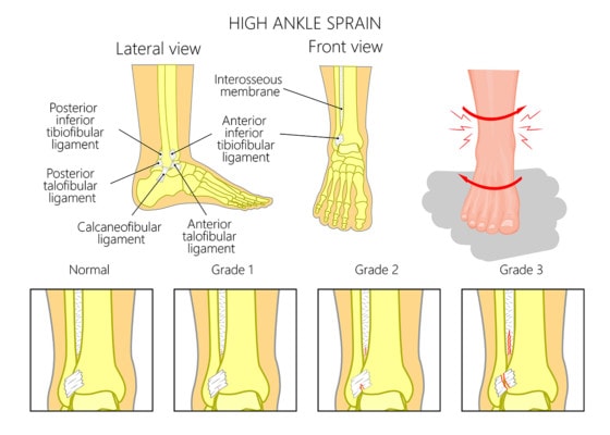 Medical infographic showing the anatomy of the ankle along with the effects of multiple grades of high ankle sprain
