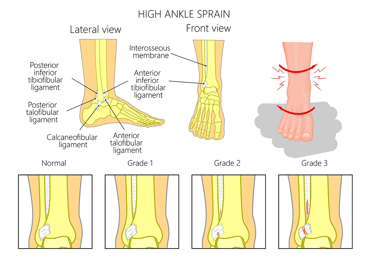 High Ankle Sprain Treatment - Burlington Sports Therapy