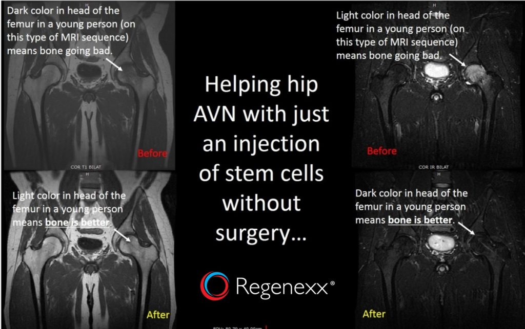 hip avn surgery alternative
