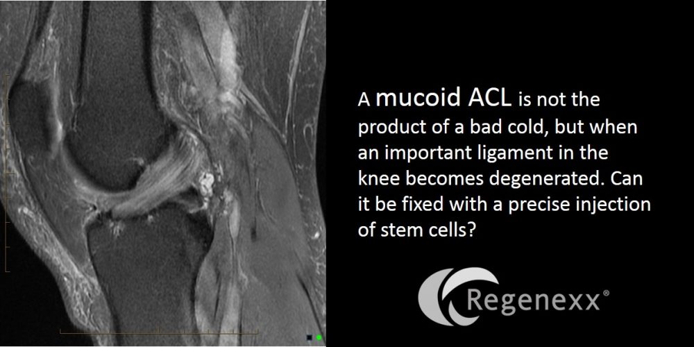 Can a Mucoid ACL be Helped with Stem Cells? What the Heck is that?