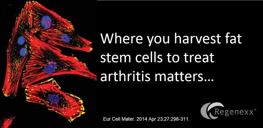 Fat Stem Cell Arthritis